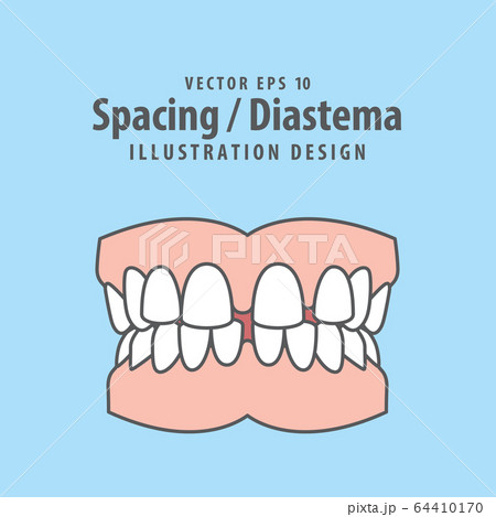 Dental spacing or diastema teeth illustration Dental spacing or diastema teeth illustration 64410170