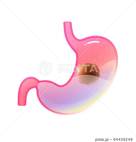 Vector isolated illustration of stomach cancer  64439249