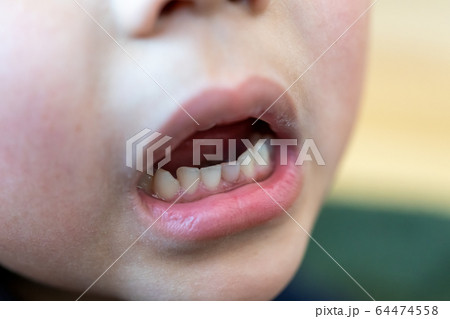 乳歯 グラグラ 乳歯 グラグラ 64474558