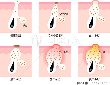 ニキビの症状と段階のイラスト素材 64478472 Pixta