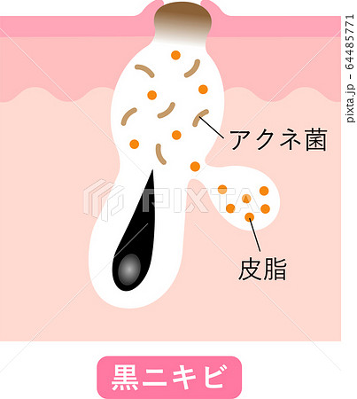 黒ニキビ　肌の断面図 64485771