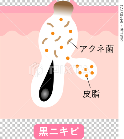 黒ニキビ　肌の断面図 64485771