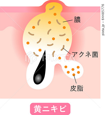 黄ニキビ 肌の断面図のイラスト素材