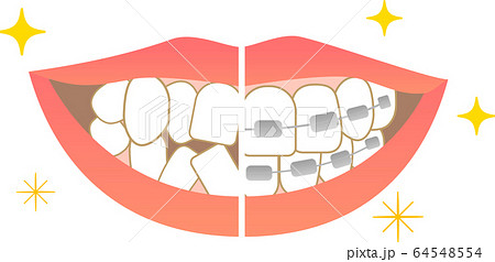 歯並びデンタルケア　矯正治療前治療後 64548554