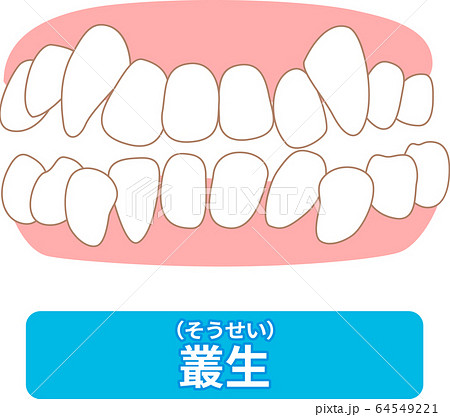 治療が必要な歯並び一覧　叢生、反対咬合、開咬、上顎前突、空隙歯列、すきっ歯 64549221