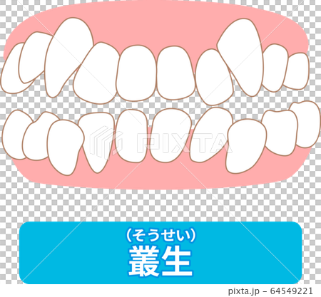 治療が必要な歯並び一覧　叢生、反対咬合、開咬、上顎前突、空隙歯列、すきっ歯 64549221