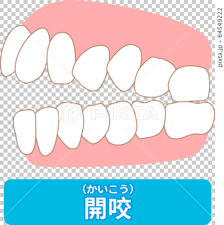 List of dentitions that require treatment: crowding, opposite occlusion, open bite, maxillary anterior protrusion, cavities, dentition 64549222