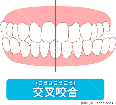 需要治療的牙列清單：擁擠，對側咬合，咬合，上頜前突，蛀牙，牙列