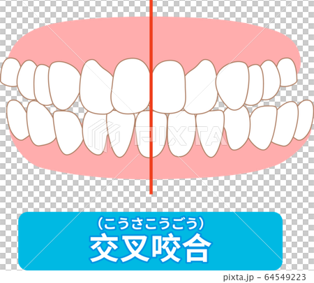 治療が必要な歯並び一覧 叢生、反対咬合、開咬、上顎前突、空隙歯列、すきっ歯 治療が必要な歯並び一覧 叢生、反対咬合、開咬、上顎前突、空隙歯列、すきっ歯 64549223