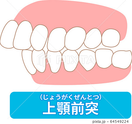 治療が必要な歯並び一覧　叢生、反対咬合、開咬、上顎前突、空隙歯列、すきっ歯 64549224