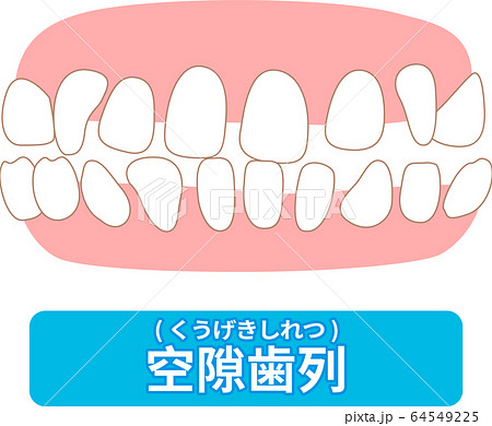 治療が必要な歯並び一覧　叢生、反対咬合、開咬、上顎前突、空隙歯列、すきっ歯 64549225