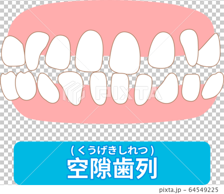 治療が必要な歯並び一覧　叢生、反対咬合、開咬、上顎前突、空隙歯列、すきっ歯 64549225