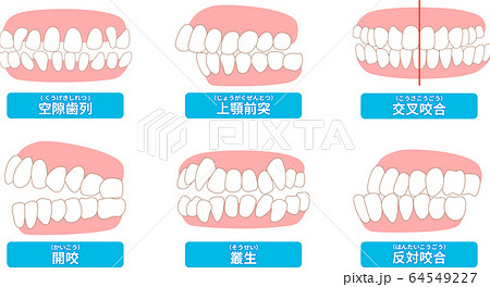 治療が必要な歯並び一覧 叢生 反対咬合 開咬 上顎前突 空隙歯列 すきっ歯のイラスト素材