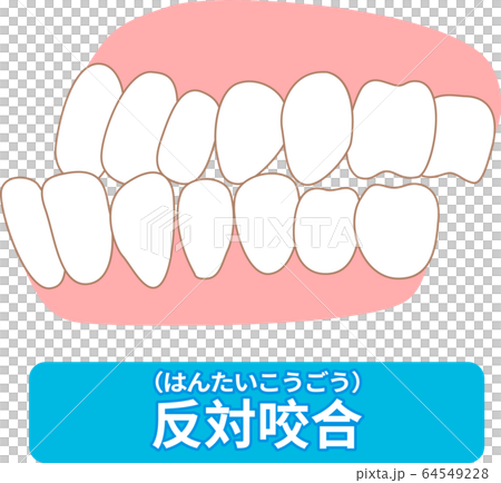 List of dentitions that require treatment: crowding, opposite occlusion, open bite, maxillary anterior protrusion, cavities, dentition List of dentitions that require treatment: crowding, opposite occlusion, open bite, maxillary anterior protrusion, cavities, dentition 64549228