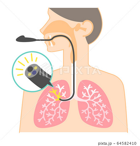 気管支鏡検査のイラスト 図表 説明図 肺カメラ のイラスト素材