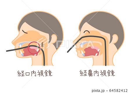 経口内視鏡と経鼻内視鏡のイラスト 胃カメラの挿入 文字入り のイラスト素材