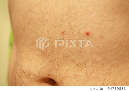 Chickenpox. Acne on the skin of a man. Close-up. Chickenpox. Acne on the skin of a man. Close-up. 64739881
