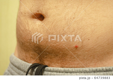 Chickenpox. Acne on the skin of a man. Close-up. Chickenpox. Acne on the skin of a man. Close-up. 64739883