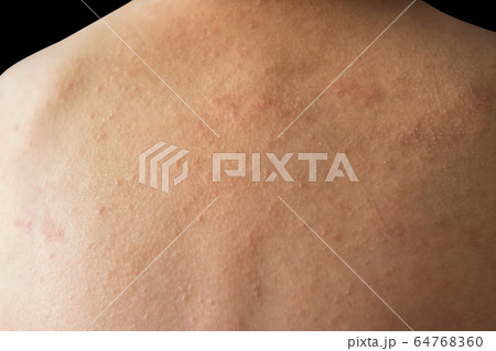 Child back with rash allergy skin Child back with rash allergy skin 64768360