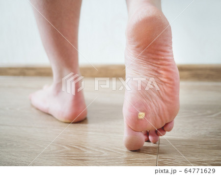 Close up photo of plantar wart on man's foot. Verruca plantaris on the heel. Close up photo of plantar wart on man's foot. Verruca plantaris on the heel. 64771629