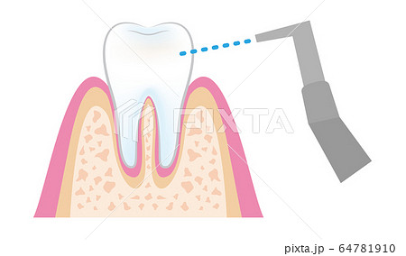 歯医者さんのイラスト歯科pmtcの手順 Dental Pmtc Step08のイラスト素材