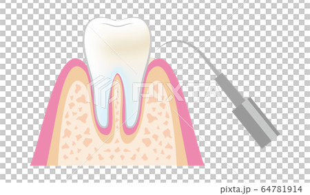 歯医者さんのイラスト歯科pmtcの手順 Dental Pmtc Step03のイラスト素材