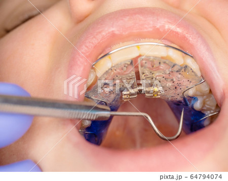 Children mouth with white blue teeth braces Children mouth with white blue teeth braces 64794074
