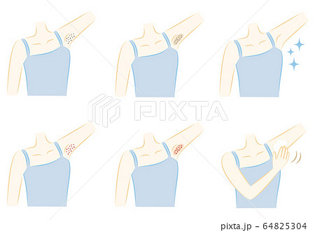 女性の脇の肌トラブル 黒ずみ 赤み 色素沈着 埋没毛 脱毛のイラスト素材
