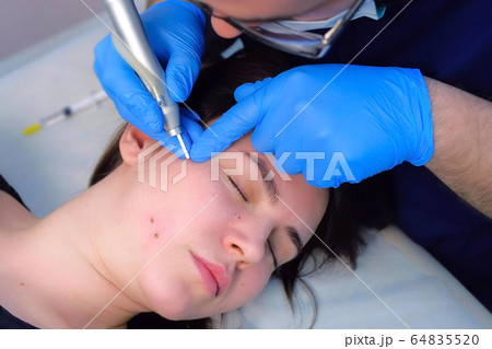 Surgeon removing mole using laser on woman face, burning skin, beauty treatment. 64835520