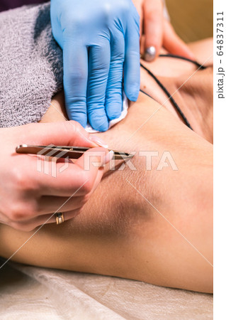 Close-up of removing armpit hair with tweezers. Female depilation. Cosmetology and beauty shop concept. Close-up of removing armpit hair with tweezers. Female depilation. Cosmetology and beauty shop concept. 64837311