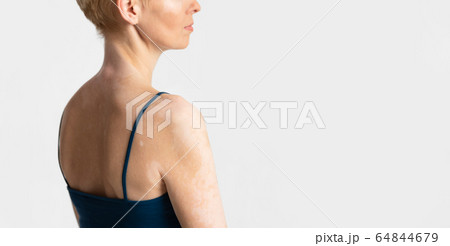 Acceptance of oneself with chronic disease, profile 64844679