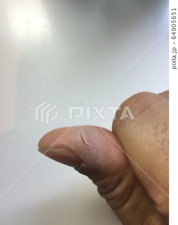 指をガラスで切ってしまった傷のアップ 指をガラスで切ってしまった傷のアップ 64905651