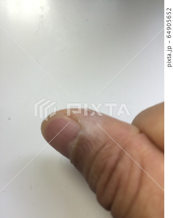 指をガラスで切ってしまった傷のアップ 64905652