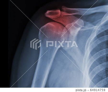 X-ray shoulder radiograph show state of injury 64914759