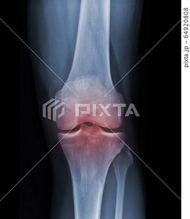 X-ray knee radiograph show state of injury X-ray knee radiograph show state of injury 64920808