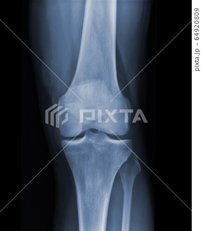 X-ray knee radiograph show state of injury 64920809
