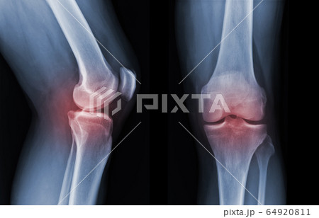X-ray knee radiograph show state of injury X-ray knee radiograph show state of injury 64920811