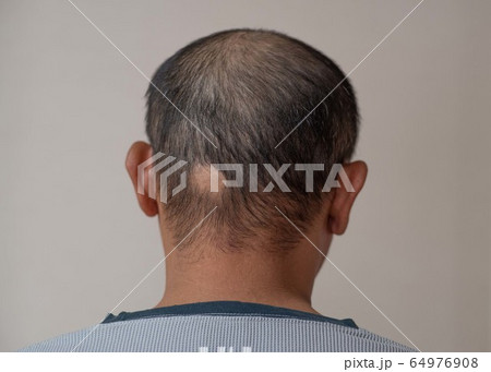 円形脱毛 64976908