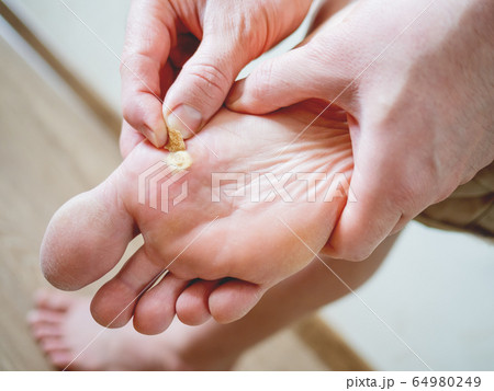 Close up photo of plantar wart on man's foot. Verruca plantaris on the heel is sealed with a salicylic plaster. Close up photo of plantar wart on man's foot. Verruca plantaris on the heel is sealed with a salicylic plaster. 64980249