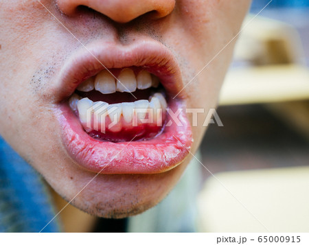 Dry mouth and bad teeth of a man on cold day close up 65000915