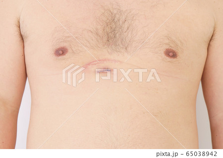 手術 傷 男性 手術 傷 男性 65038942