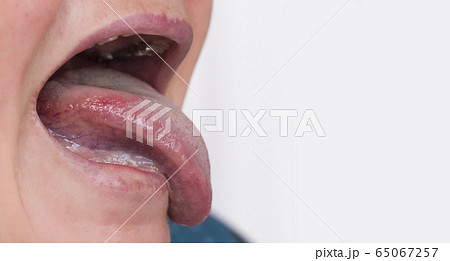 Woman with a disease and redness of the tongue. Glossitis and gingivitis disease concept, copy space Woman with a disease and redness of the tongue. Glossitis and gingivitis disease concept, copy space 65067257