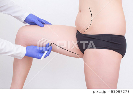 Doctor plastic surgeon makes a marker marker for a modern operation to remove subcutaneous fat from the hips and abdomen of a girl. Sociology of Plastic Surgery, Abdominoplasty and Laser Lipolysis Doctor plastic surgeon makes a marker marker for a modern operation to remove subcutaneous fat from the hips and abdomen of a girl. Sociology of Plastic Surgery, Abdominoplasty and Laser Lipolysis 65067273