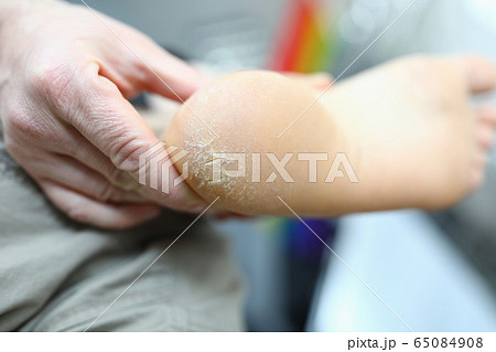 Dermatology problem and dryness 65084908