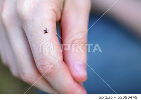 Mite on child's hand.  65090449