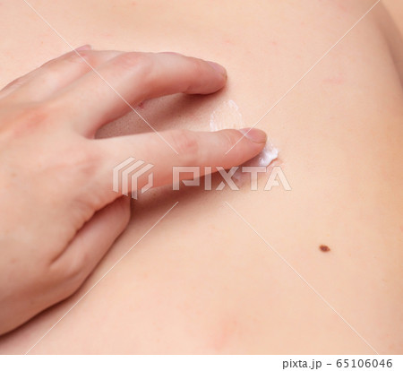 A girl smears a scar on her body with a healing cream to heal scars and scars, close-up, copy space A girl smears a scar on her body with a healing cream to heal scars and scars, close-up, copy space 65106046