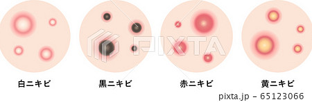 ニキビの症状　肌 65123066