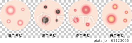 痤瘡症狀皮膚 痤瘡症狀皮膚 65123066