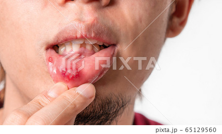 Asian man have aphthous ulcers on mouth on white Asian man have aphthous ulcers on mouth on white 65129560