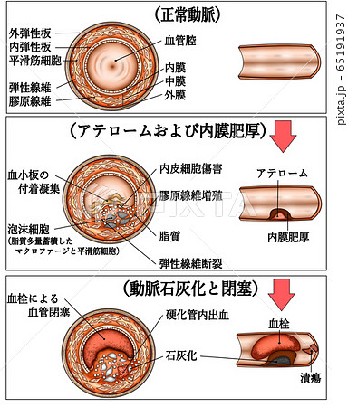 血管動脈硬化イラスト文字付きのイラスト素材 65191937 Pixta